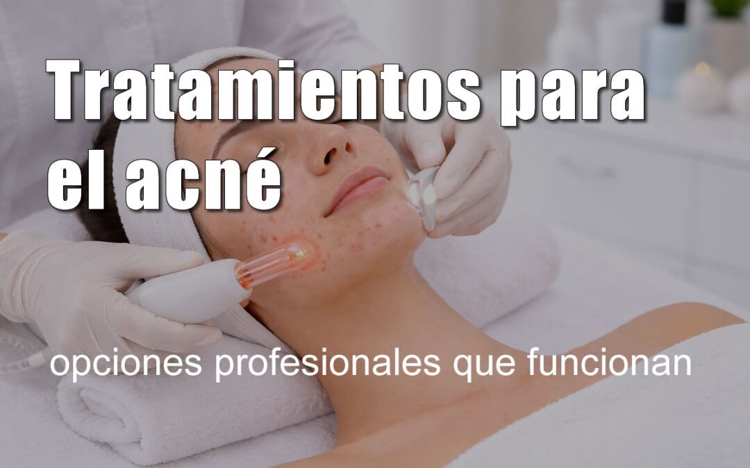 Tratamientos para el acné: opciones profesionales que funcionan
